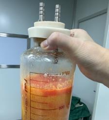 新泰水动力吸脂手术要做多久？